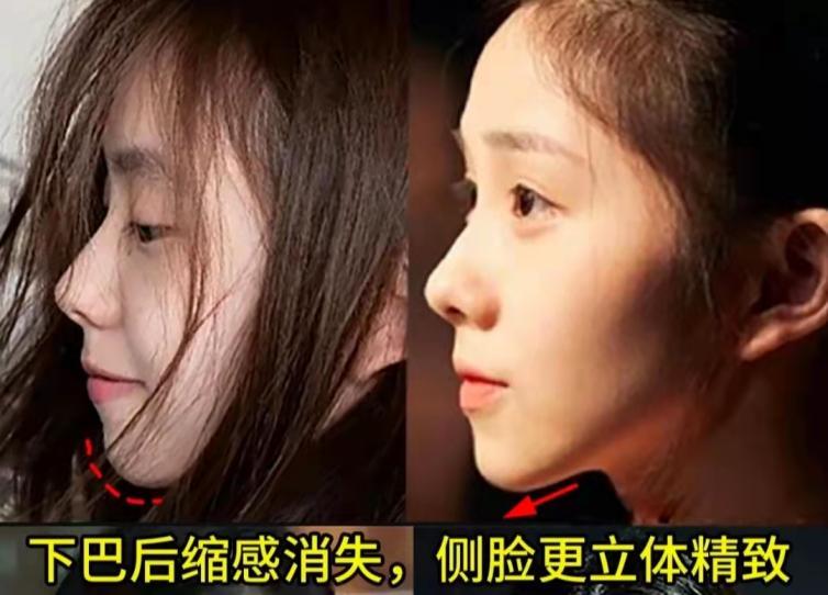 垫下巴玻尿酸还是假体好?有哪些后遗症?