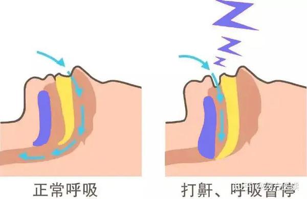 打鼾=睡得香?鼾声如雷警惕睡眠呼吸暂停综合征! - 知乎