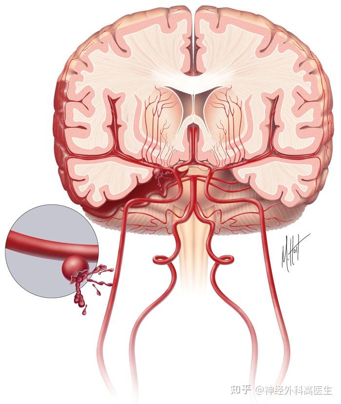 动脉瘤脑出血严重吗
