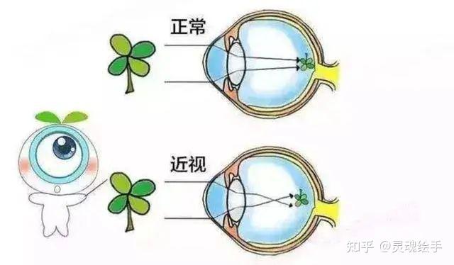 怎么才能恢复视力怎么才能恢复视力,眼睛近视后是不可逆的,我们应该