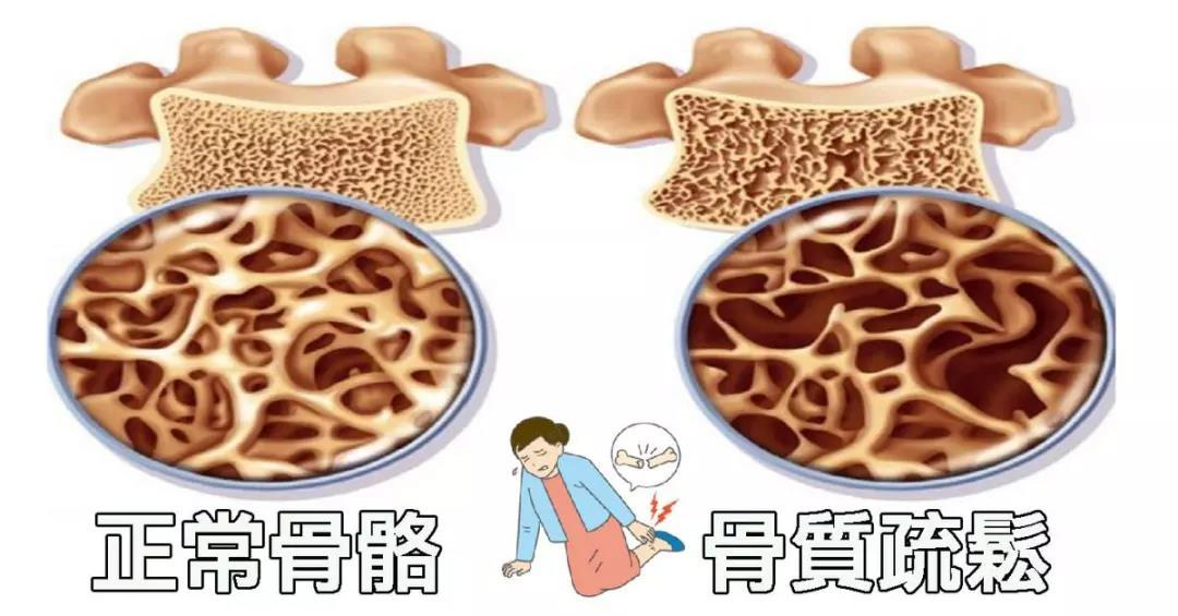 骨头汤和牛奶到底哪个更补钙?