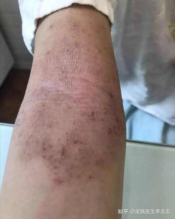 什么是特应性皮炎?中医如何治疗特应性皮炎? - 知乎