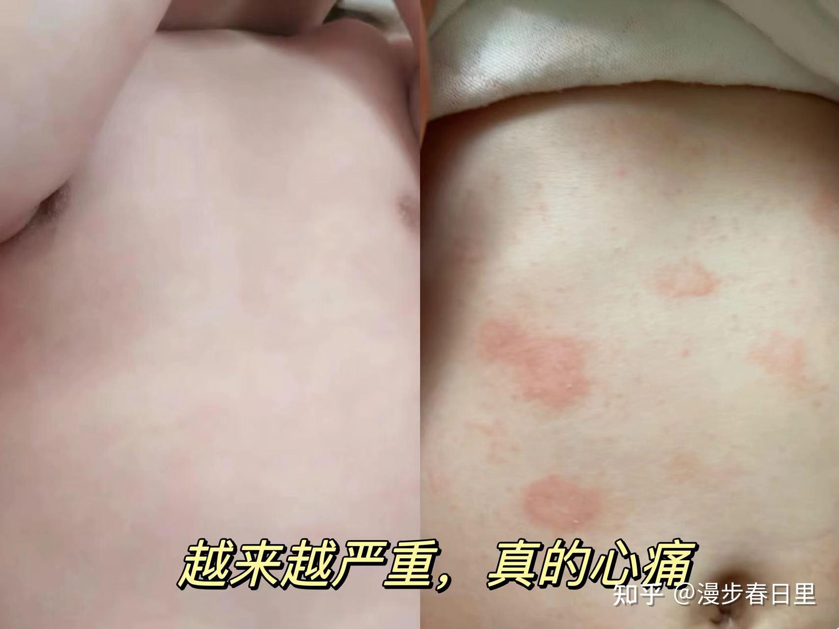 最近在小红书看到一个妈妈把沐浴油当成抚触油结果孩子皮肤大面积过敏