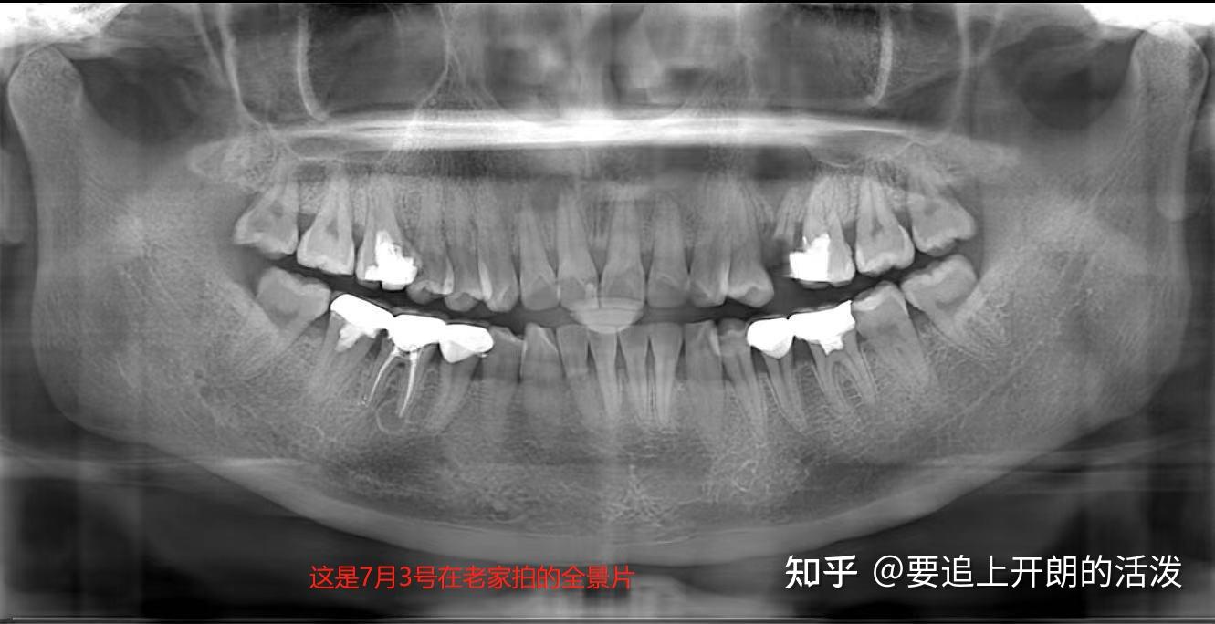 记录口腔保健根尖囊肿根管治疗拔智齿