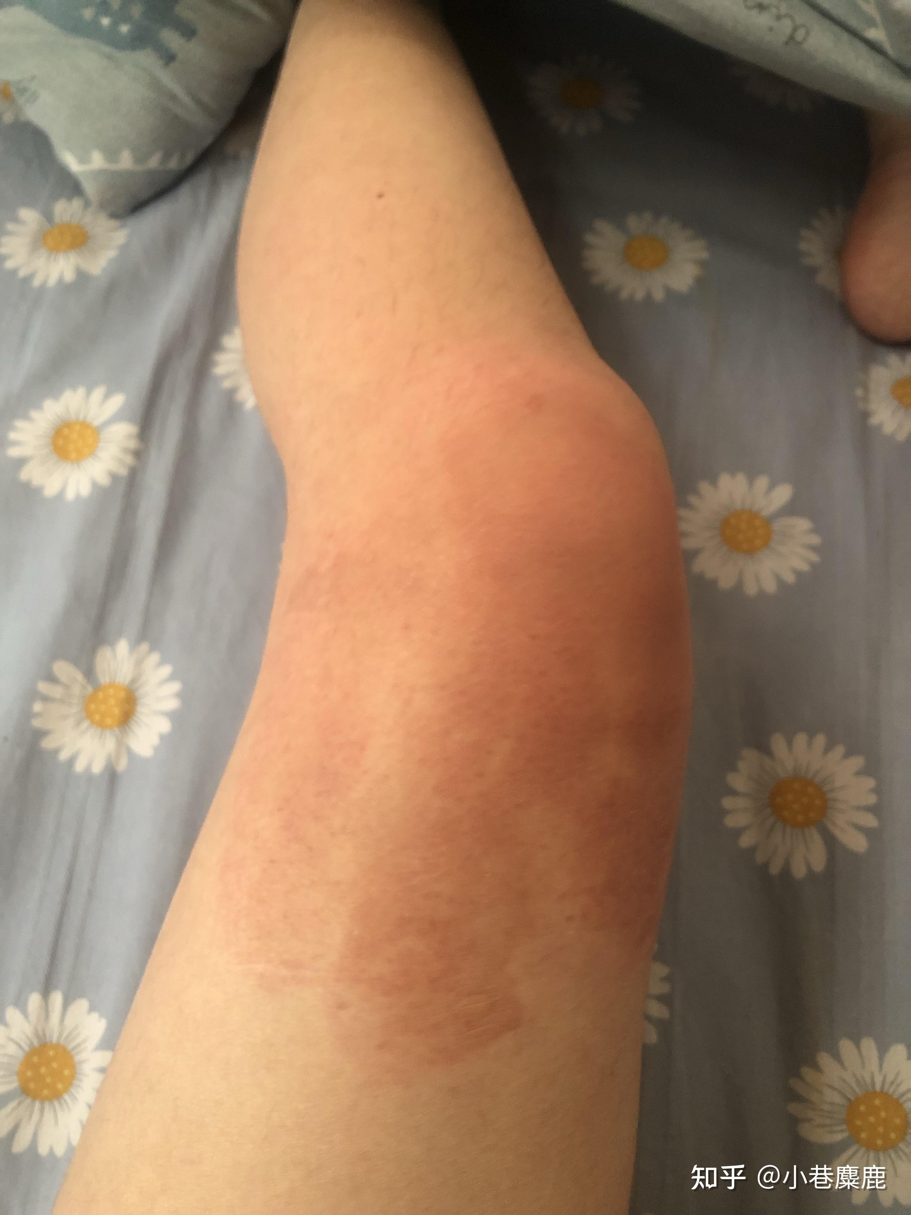 腿部被开水烫伤的恢复记录