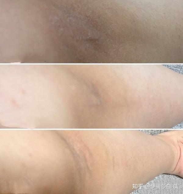 另外加上屁股上血流不丰富,挤压之下很容易出现局部缺血的表现,就跟黑