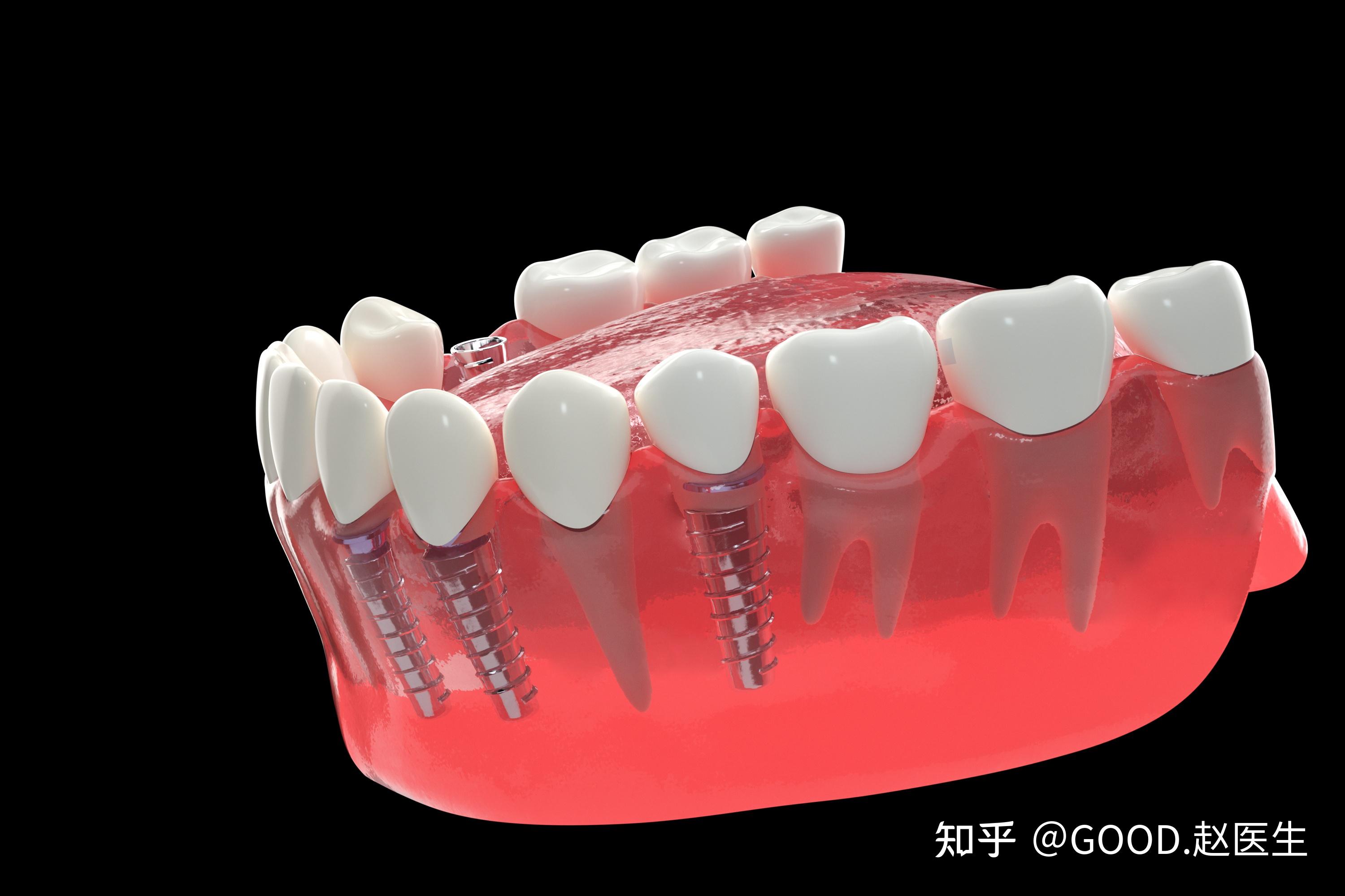 南京固德口腔医院表示,半口牙种植的准备工作,如下所述:一,种植牙手术