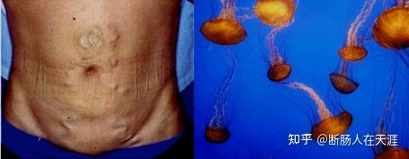 海蛇头门静脉血流经脐旁静脉与腹上深静脉,腹下深静脉吻合,分别流入上