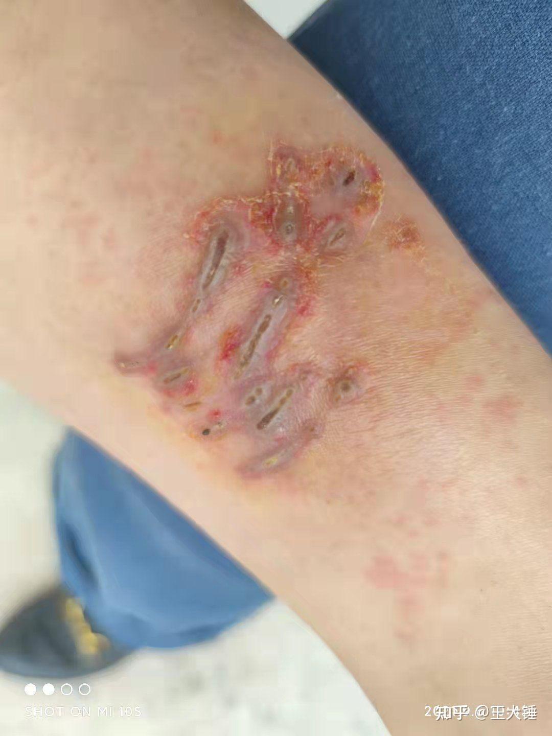 养猫被猫咬连医生都说我是他从医以来看过被猫咬的最狠的患者