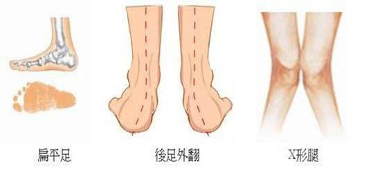 足外翻的自我矫正 - 知乎