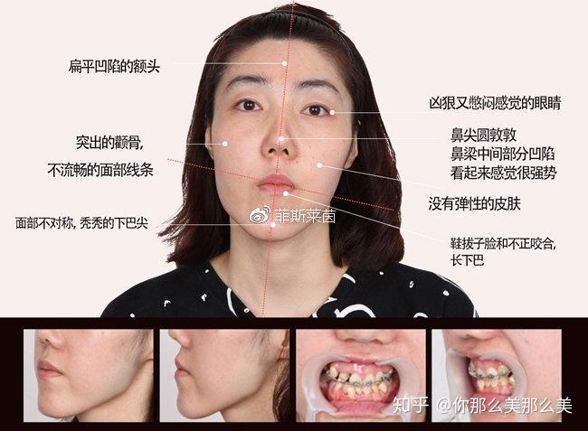 通过双鄂手术将上下颚移动到正常位置,看起来长的脸型和鞋拔子脸预计