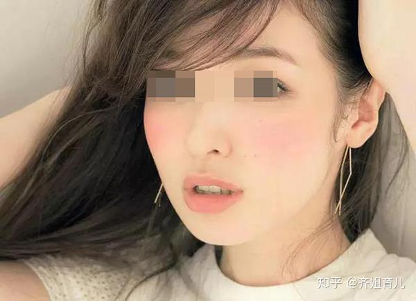 面色经常赤红,整个脸反光,亮亮的,鼻头发红发亮,头发硬直,眼角周围有