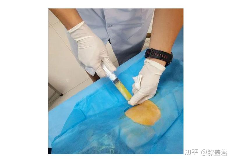 滑囊炎是骨凸起部位或者肌腱经常活动部位反复摩擦引起的渗出在局部