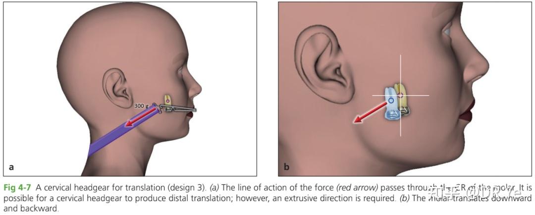 chapter4头帽口外弓headgear3