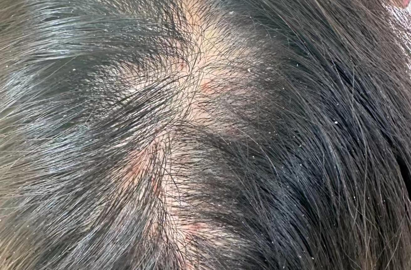 从医学角度来看,为什么头皮泛红长痘一定要抑菌除螨双管齐下? - 知乎