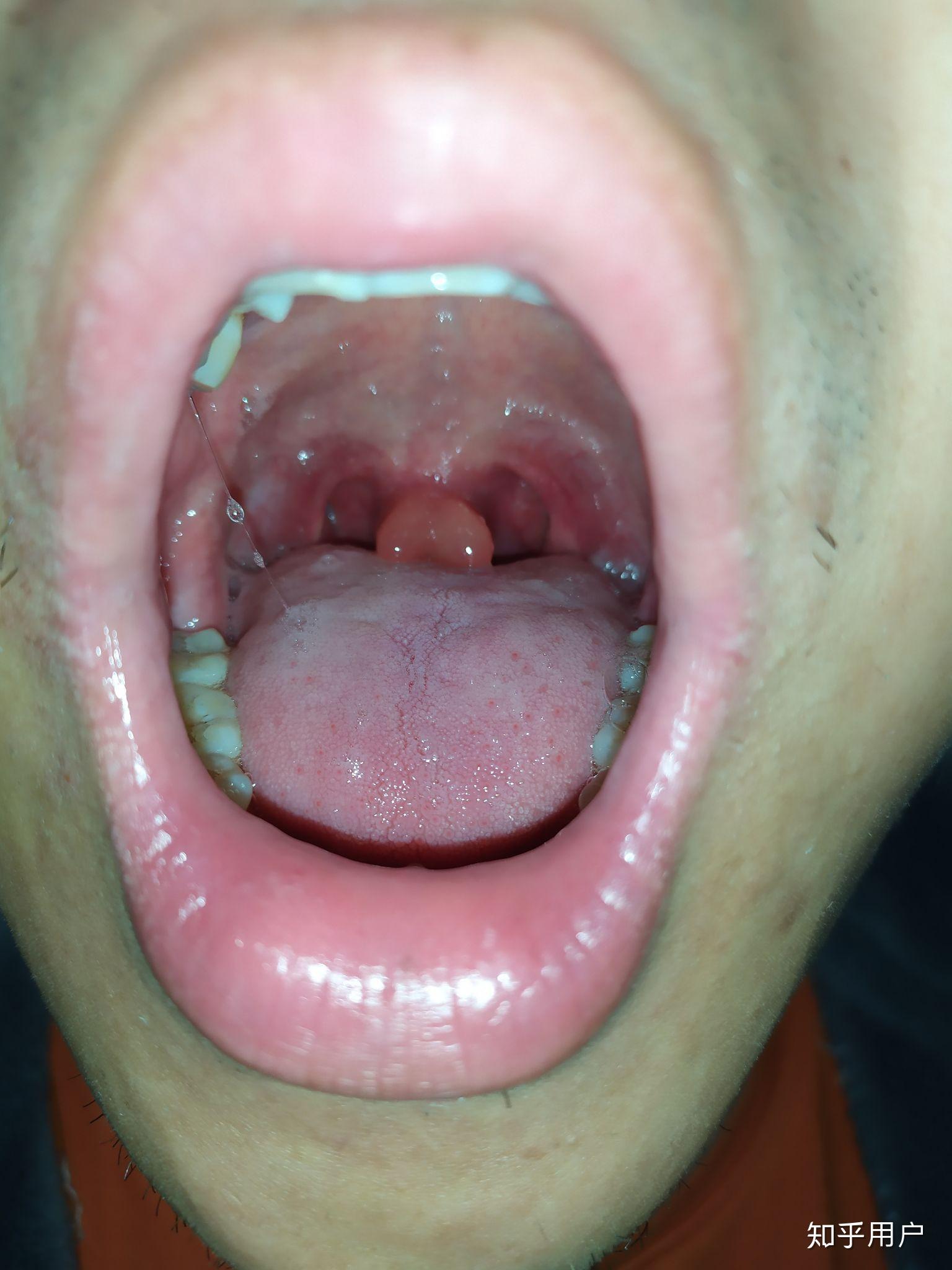 什么是回吸性鼻涕 v2-2afbddbd585165d79dc210634c200023_r.jpg