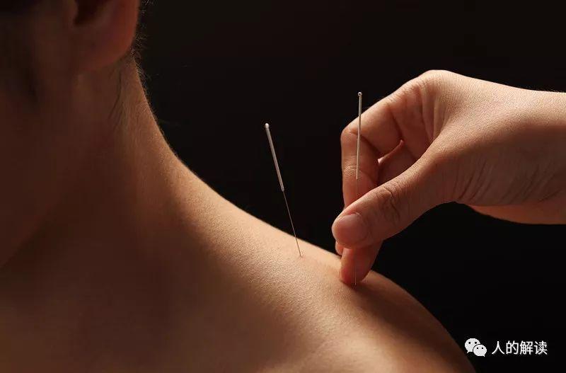 针灸治病的原理,想不到竟然是这样的 - 知乎