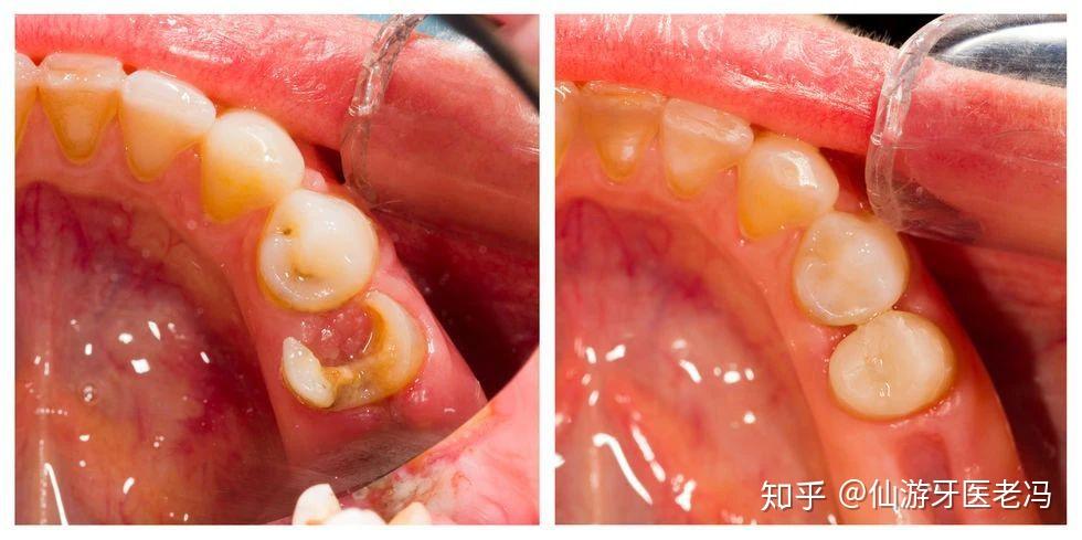 接近牙齒顏色的填充材料,粘接性還不錯,特別耐磨抗腐蝕,關鍵補牙後還