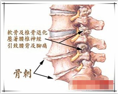 骨刺不同部位各有哪些症状?该如何护理呢?