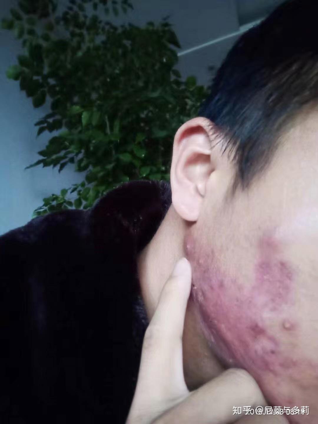 需要打点滴消炎,每日甲硝锉清洗创面,继续吃吃治疗痤疮的药物(异维a酸