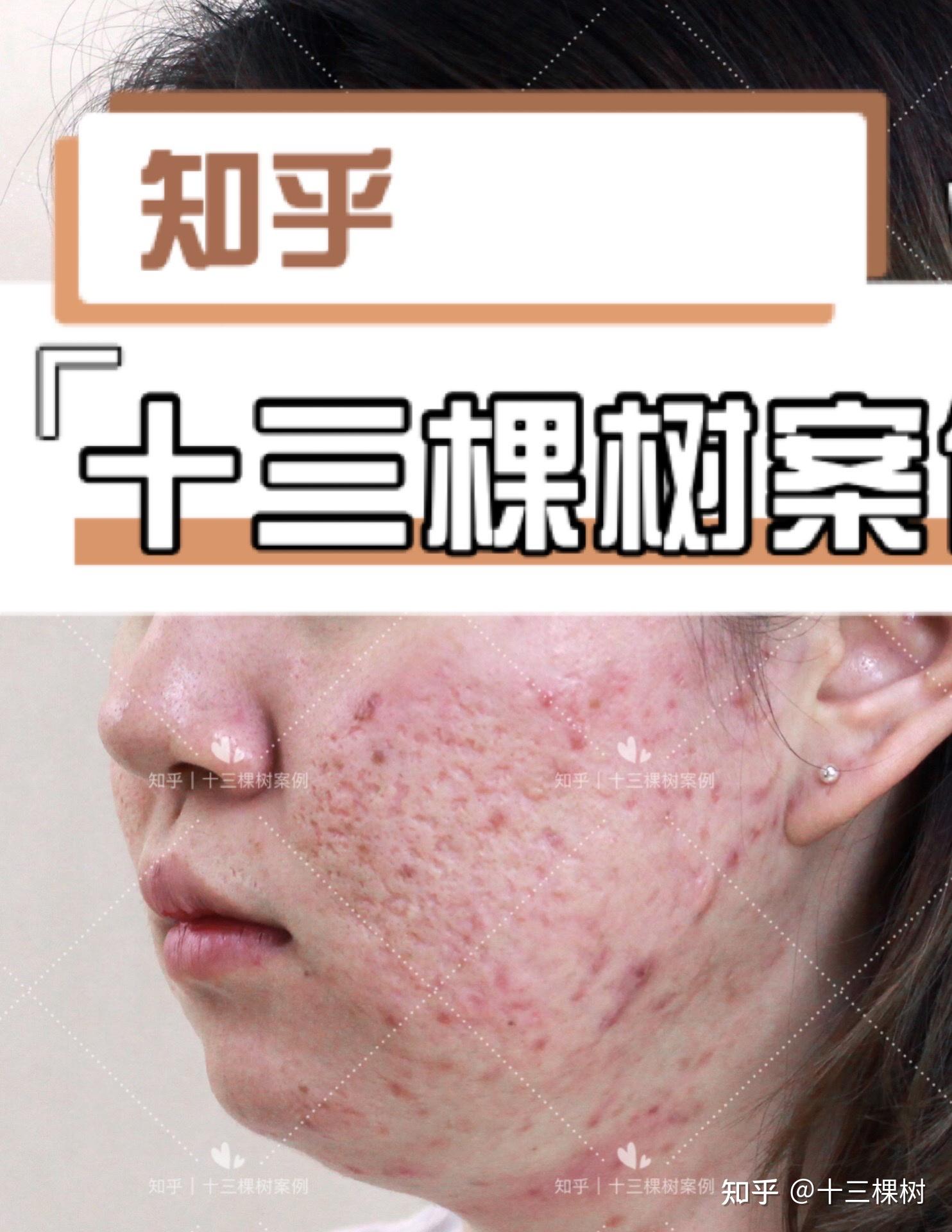 拯救毁脸式痘坑丨修复对比