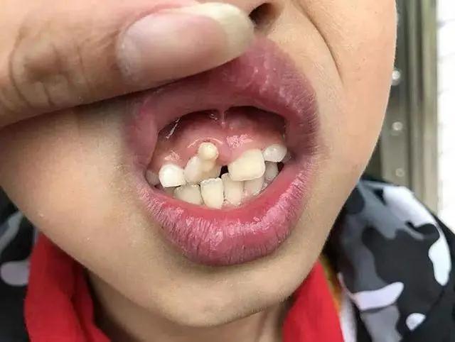 所以就会形成恒牙,乳牙挤成一堆的情形出现,导致孩子的牙齿无法排列