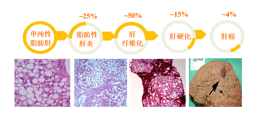 脂肪肝和肝癌一念之間這些方法讓你逆轉脂肪肝