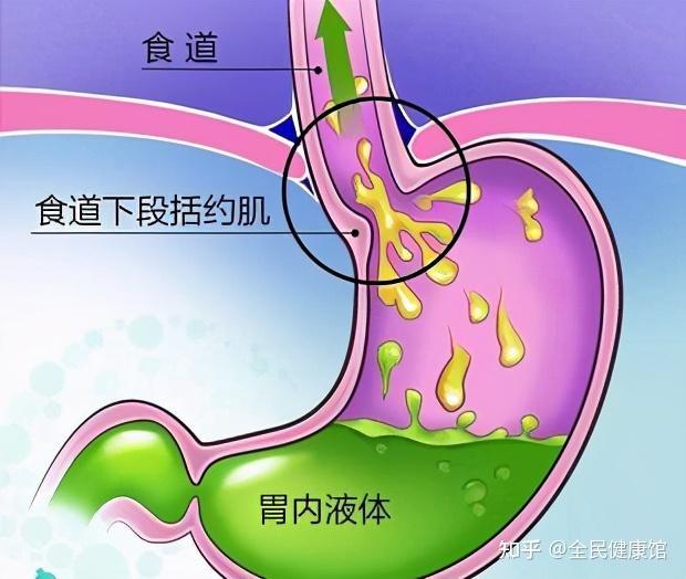 胃酸往上反酸水烧嗓子吃什么药？百分之90的胃病患者都在用！ - 知乎