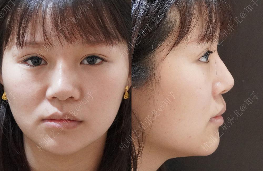 隆鼻老了以后会怎么样