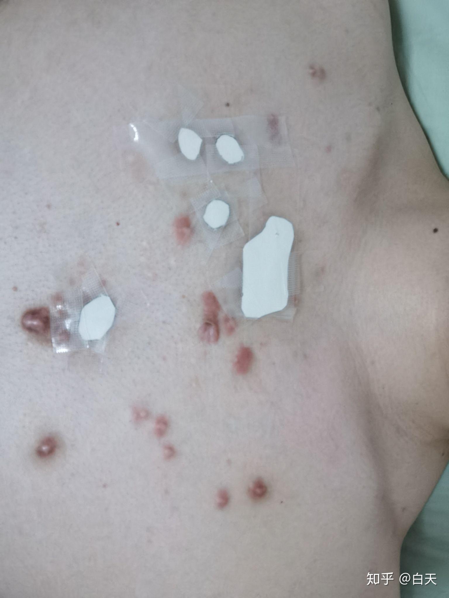 开个同位素敷贴治疗疤痕疙瘩的帖子 持续更新各位朋友有治好的可以说