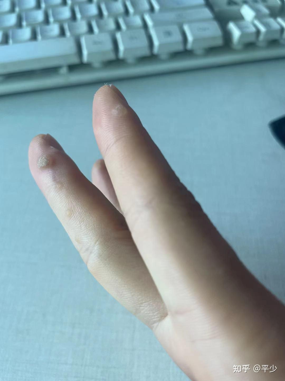 手上的这种小疙瘩去冷冻就好了 !