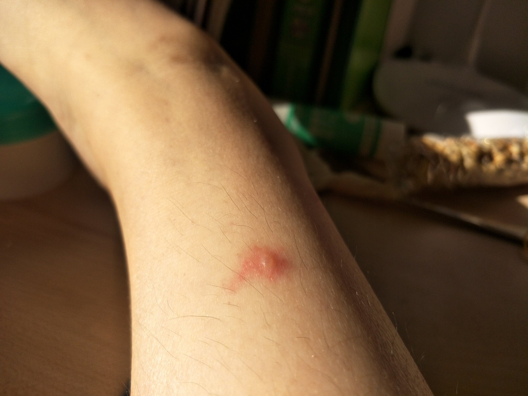 这是螨虫咬的吗还是什么情况