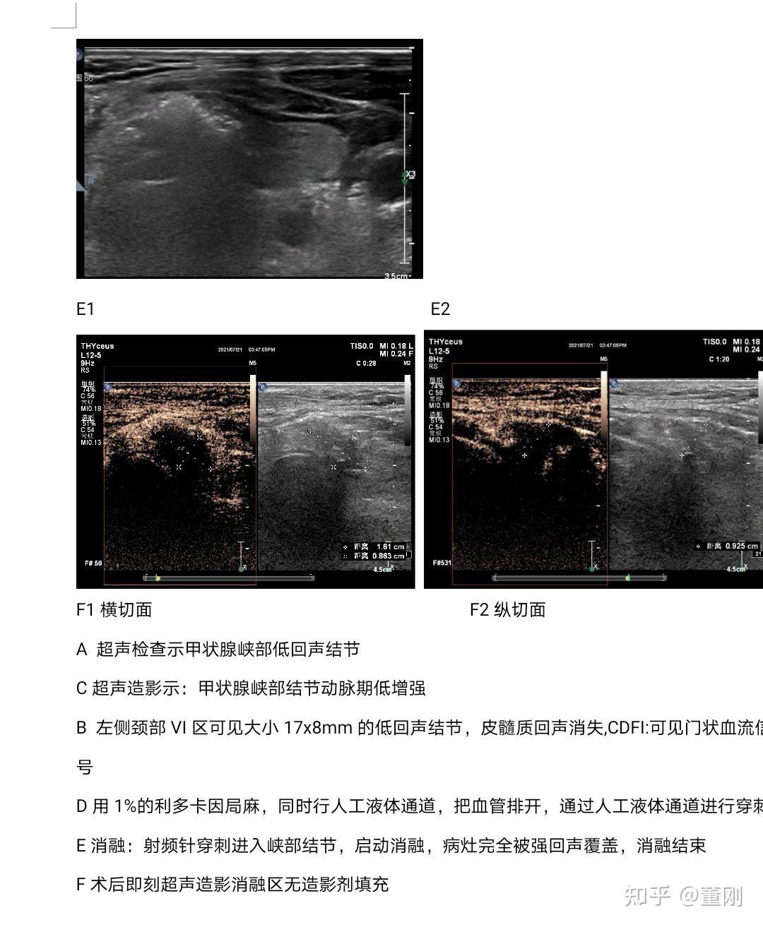 甲状腺乳头状癌伴淋巴结肿大消融一例