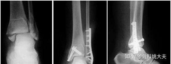 脚踝骨折保守治疗 大概多久能够恢复正常 知乎