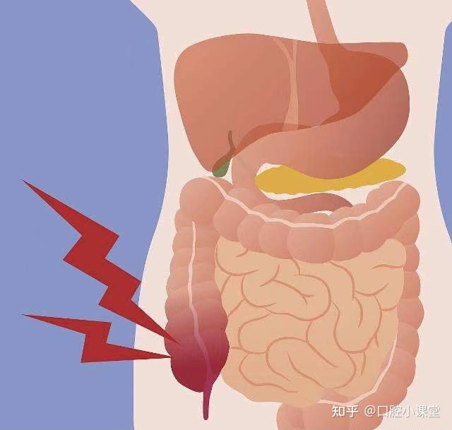 口腔執醫考試急性闌尾炎是怎麼引起的