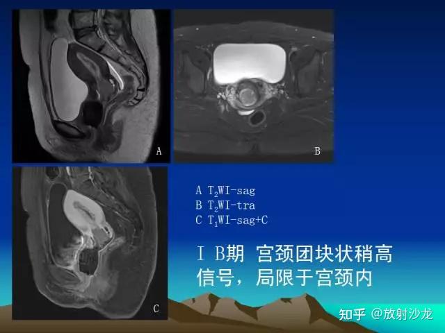 子宫常见疾病的MRI诊断 - 知乎