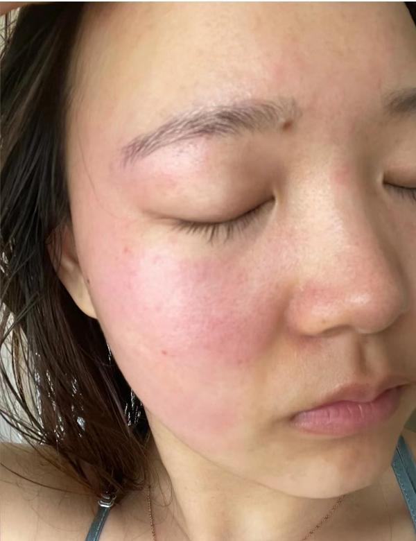 确认皮肤受损无疑了.