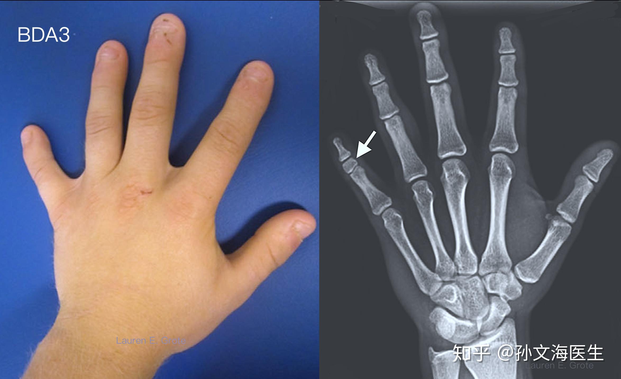 短指的改良bell分型e 掌骨短小,指骨长度正常(e1: 第四跖骨短小症d