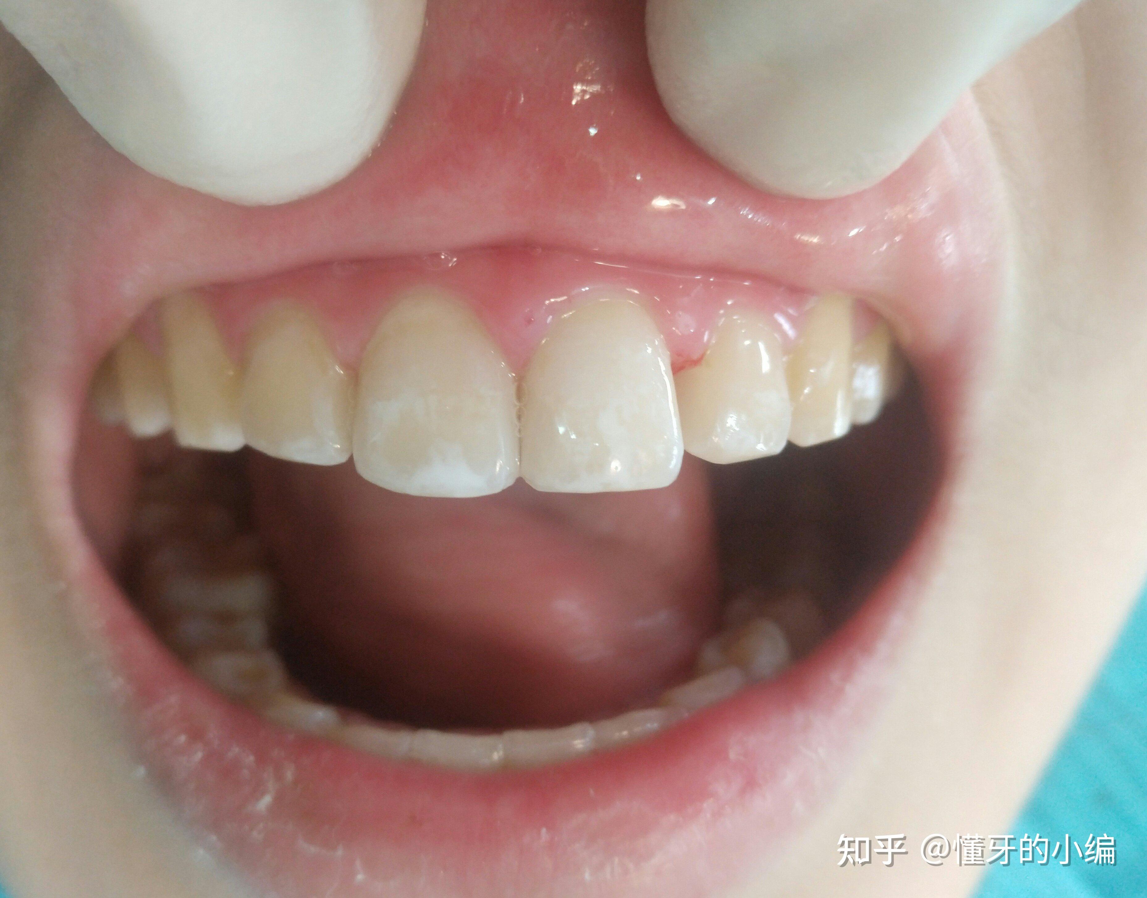 牙齿龋坏治疗案例|隐龋治疗领面龋治疗 - 知乎