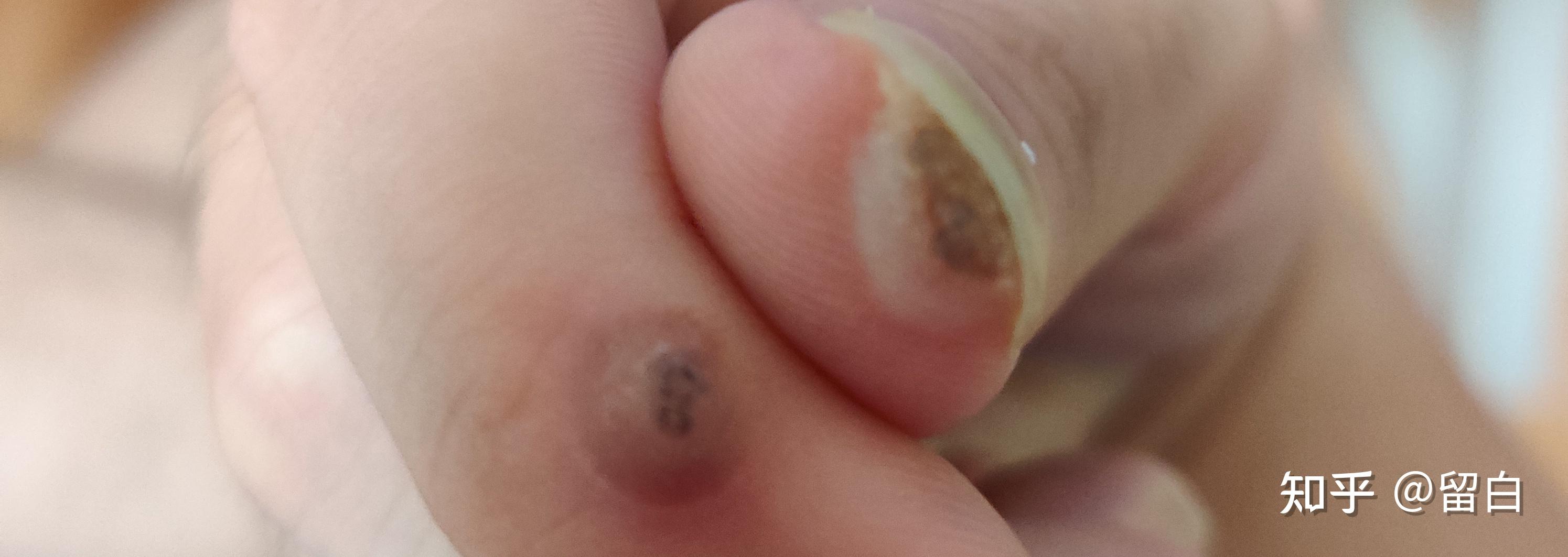 液氮冷冻甲下疣治疗记录 - 知乎