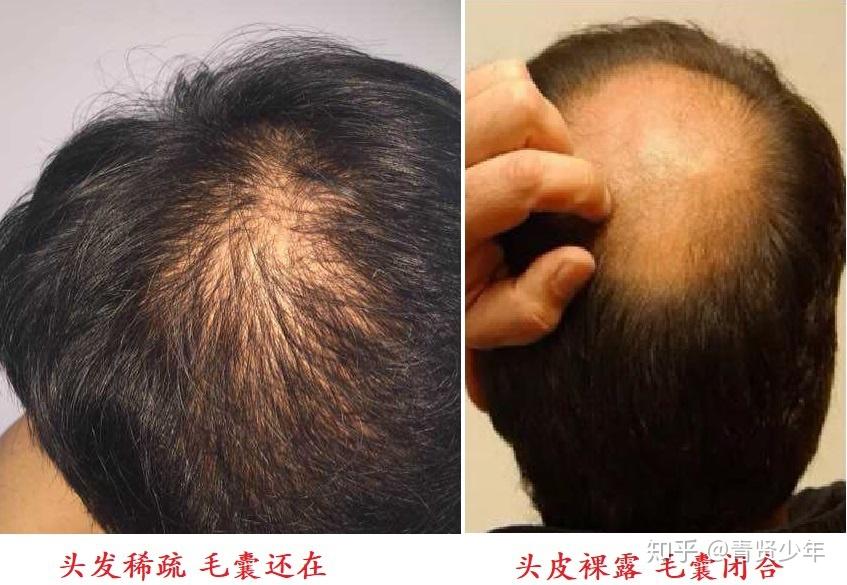 脱发用米诺有什么副作用_健康的头发使用米诺会掉头发吗_脱发4级用米诺有没有用