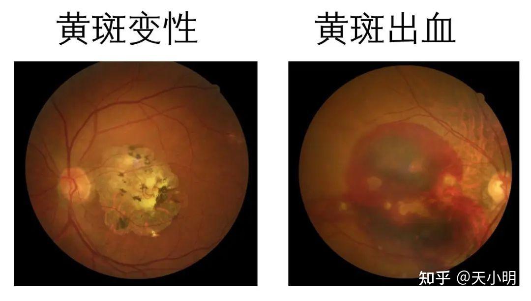 如後鞏膜葡萄腫,豹紋狀眼底,視盤的近視萎縮弧等,嚴重