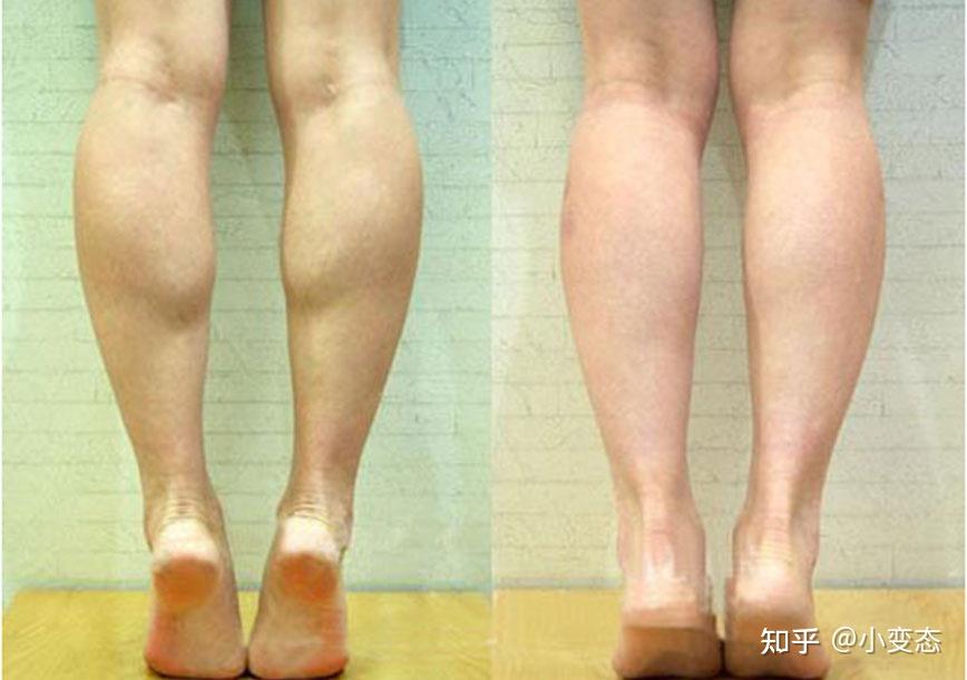 从医美角度谈谈如何改善腿型xo型腿改善国内哪些医生擅长做腿型改善