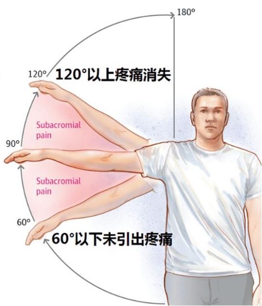 neer试验图片