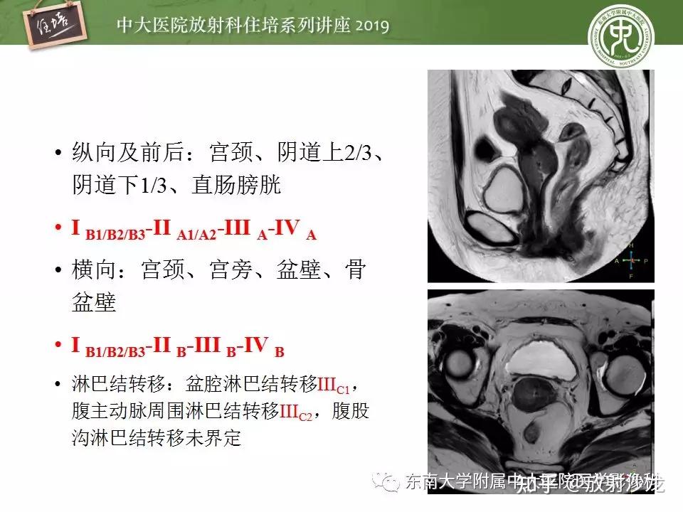 子宫详细解剖及磁共振信号分析 - 知乎