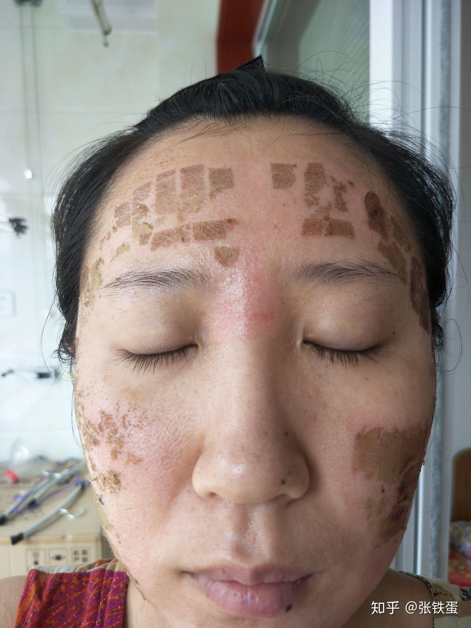 祛痘坑第六次二氧化碳激光