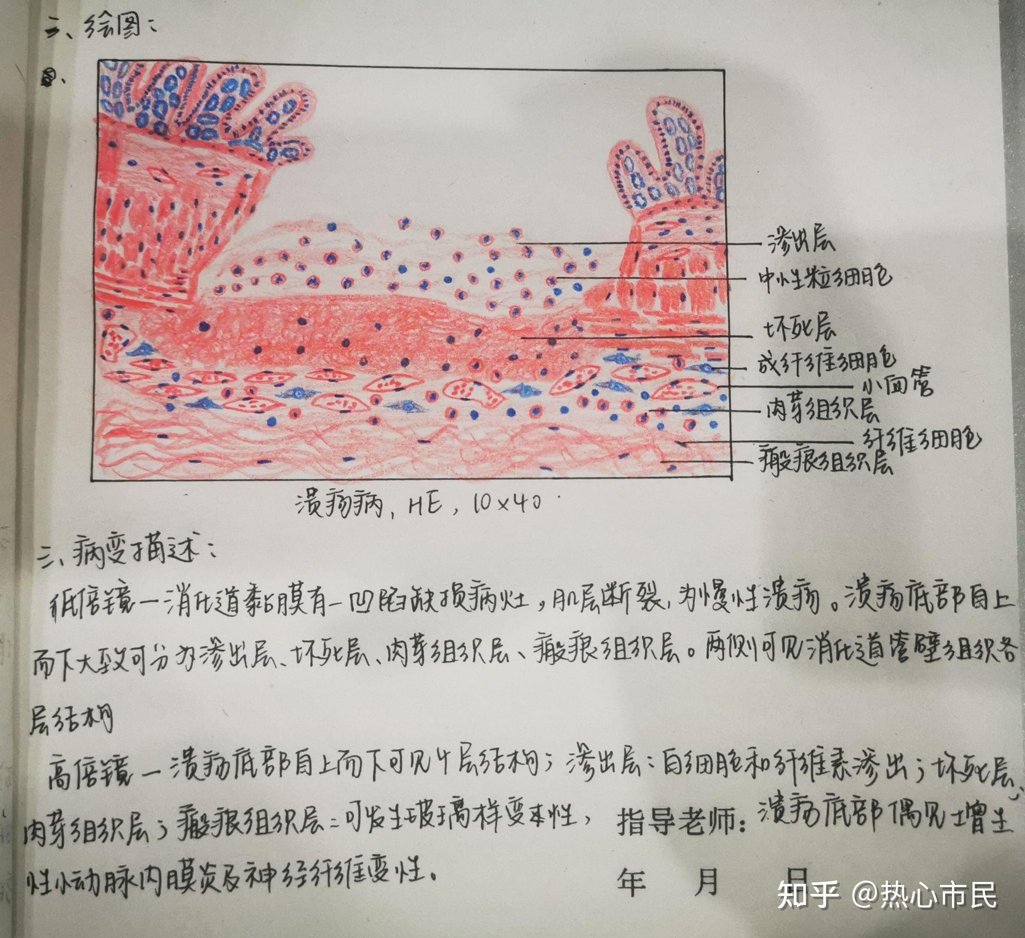 胃溃疡红蓝铅笔图图片