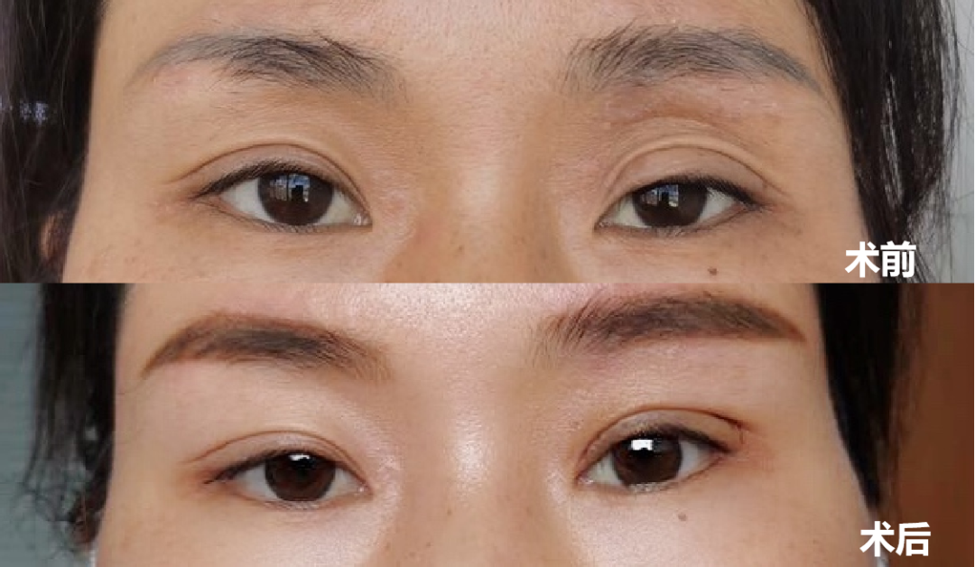 杭州眼科医院眼睑下垂手术-近视手术_杭州全飞秒激光近视手术医院