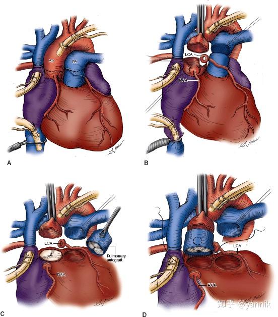中青年患者主动脉瓣疾病没有标准答案的人生考题