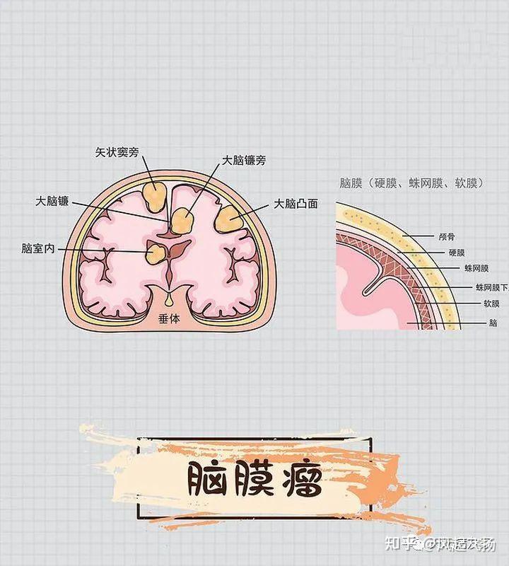 脑膜瘤位置图解图片